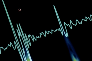 New Guidelines Update Treatment Options For Atrial Fibrillation ...