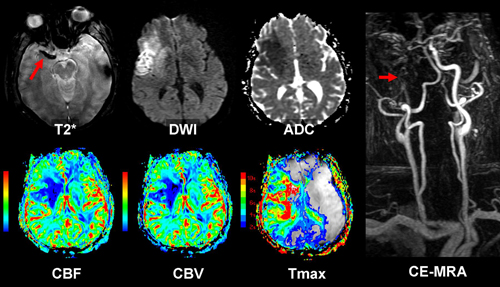 Emergency Stroke Magnetic Resonance Protocol - Figure 2