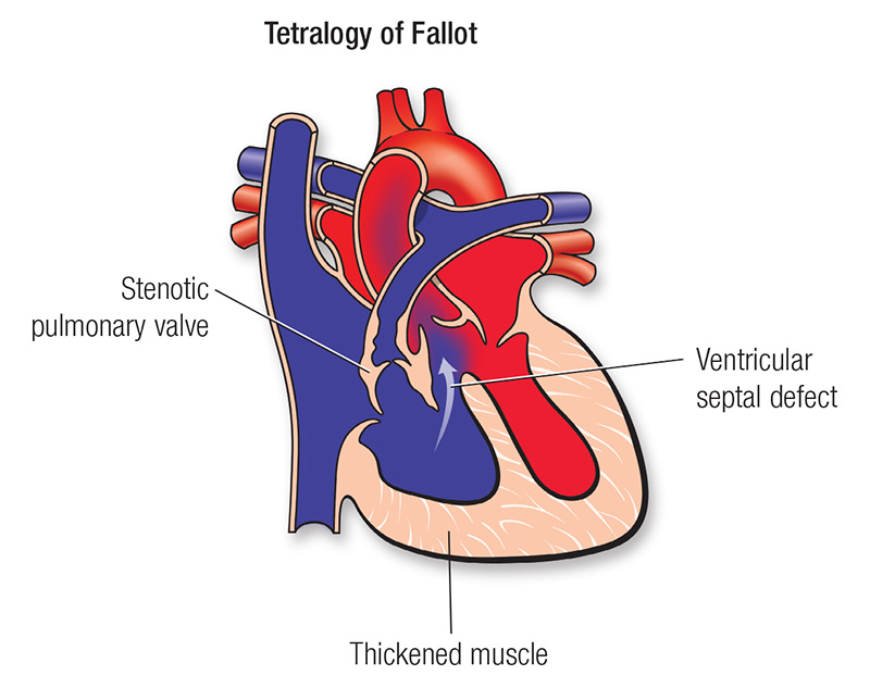 Tetralogy of Fallot diagram