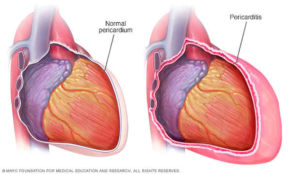Illustration showing difference between normal pericardium and pericarditis