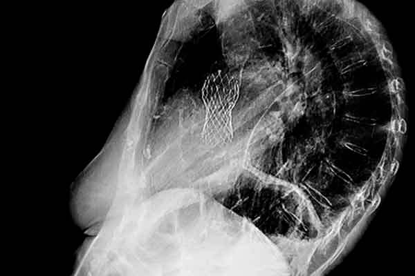 Xray of chest (lateral) showing aortic valve replacement