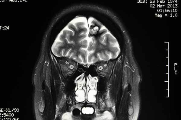 A vascular malformation showing in an MRI.