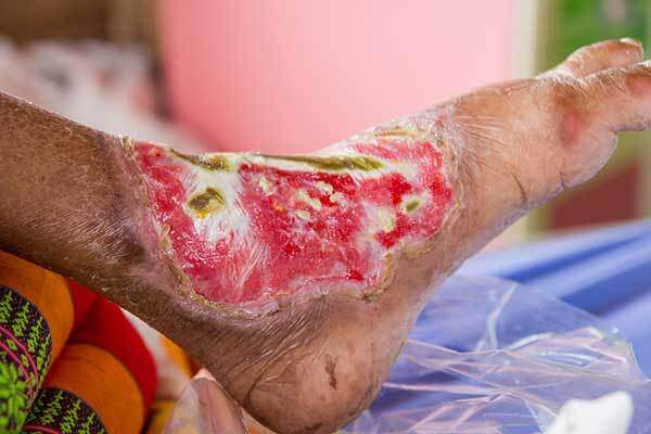 Image of diabetic foot wound