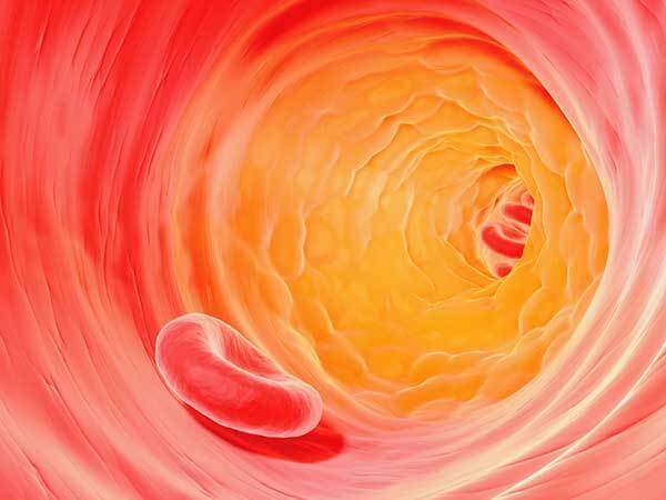 Illustration of cholesterol plaque in artery