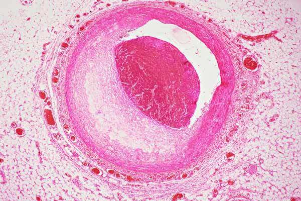 Coronary Artery slide