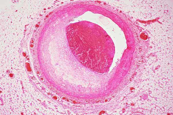 Coronary Artery slide