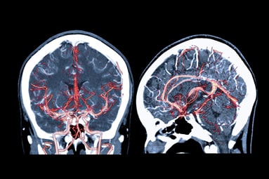 CT angiography imaging of the brain showing vessels in human head