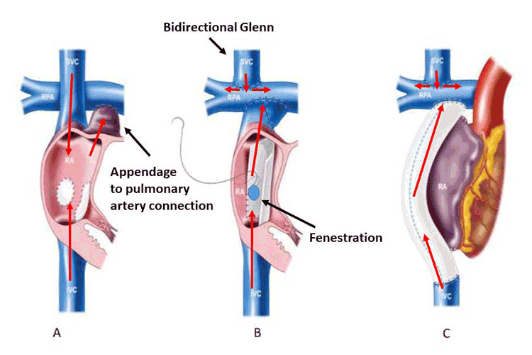 Fig 1: Variations of Fontan anatomy: Classic atriopulmonary connection (A), lateral tunnel (B) and extracardiac conduit (C). Direction of venous blood flow is illustrate by red arrows.