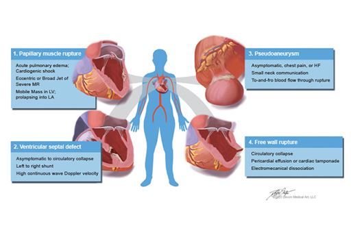 Figure 2: Clinical characteristics of Mechanical Complications of Acute Myocardial Infarction