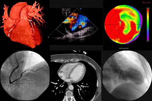 valvular echocardiogram