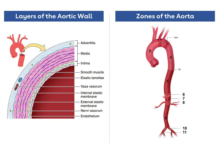 diagram of the layers of the aortic wall and the zones of the aorta