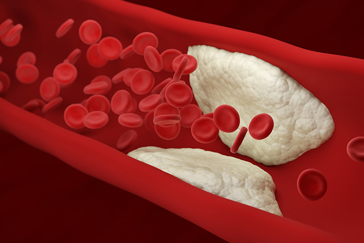 Lipoprotein(a): A Genetically Determined, Causal, and Prevalent