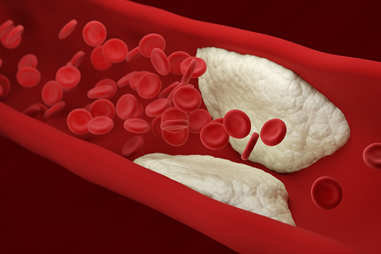 Atherosclerosis. Plaque builds up inside an artery. Blood cells. 3d illustration.