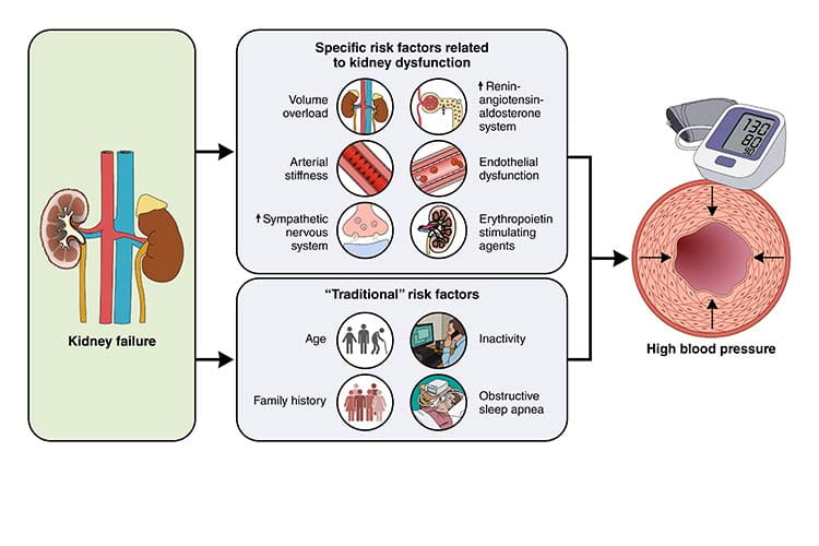 Infographic:  Kidney Failure - Specific risk factors related to kidney dysfunction: Volume overload, Renin angiotensin aldosterone system, Arterial stiffness, Endothelial dysfunction, Sympathetic nervous system, Erythropoietin stimulating agents | Traditional risk factors: Age, inactivity, Family history, Obstructive sleep apnea - High blood pressure