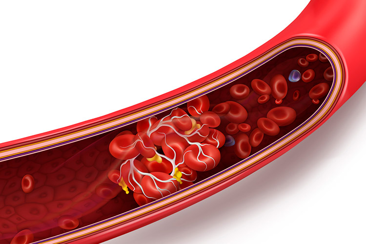 blood clot thrombus in vein