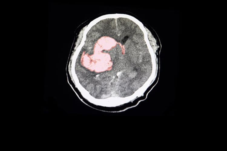brain scan intracerebral hemorrhage