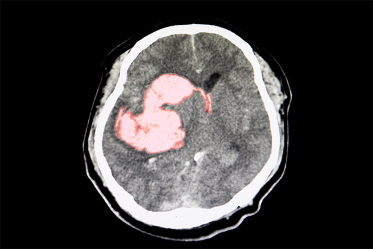 A CT scan of a stroke patient showing intracerebral hemorrhage in the Cd clots at right thalamus, basal gangliconic and lateral ventricle with brain edema and shifting of flux celebri to the left. Severe hypertensive stroke.