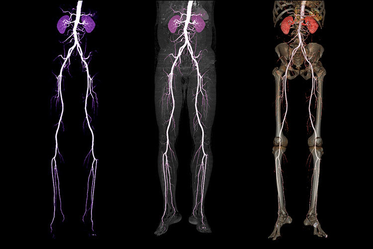 Comparison of CTA femoral artery run off - 3D rendering image of femoral artery with kidney for Patients Presenting with Acute or Chronic Peripheral Arterial Disease