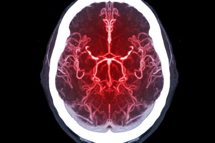 CTA Brain or CT Angiography of the Brain MIP Technique
