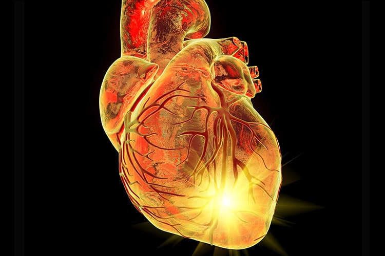Conceptual computer illustration of a heart attack