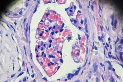 hypertension renal under microscopy