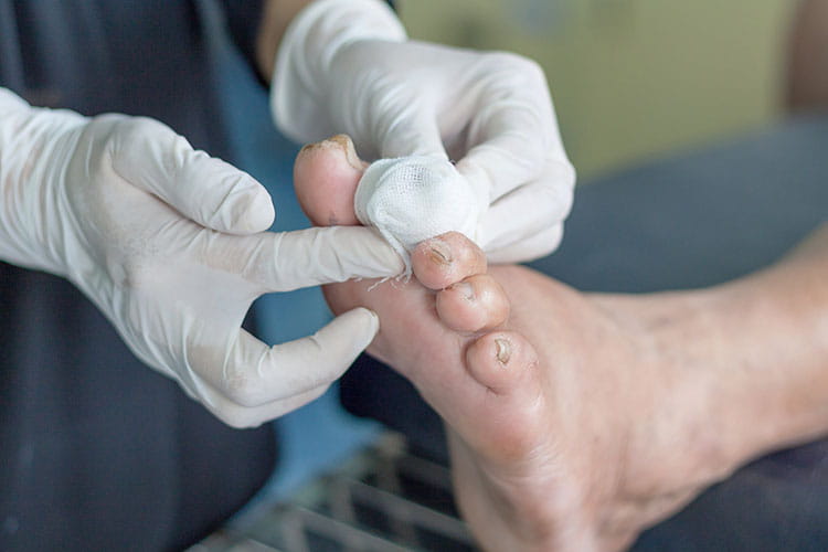 Offloading Diabetic Foot Ulcers: Albuquerque Associated Podiatrists: Board  Certified Foot and Ankle Surgeons