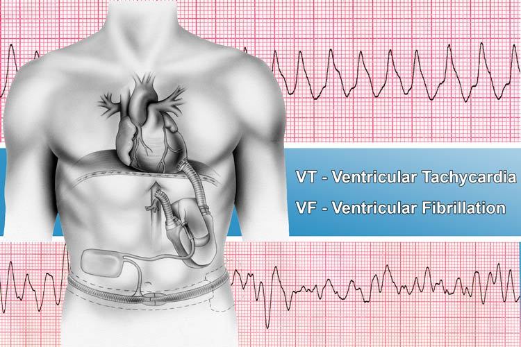 Illustration showing a male torso wearing an LVAD device with a ECG readout in the background showing ventricular-tachycardia and ventricular fibrillation.