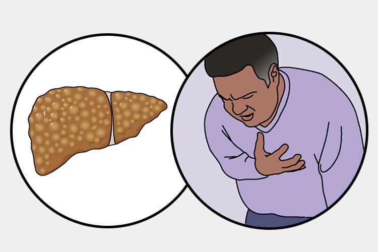 Illustration of a fatty liver and a man having chest pains
