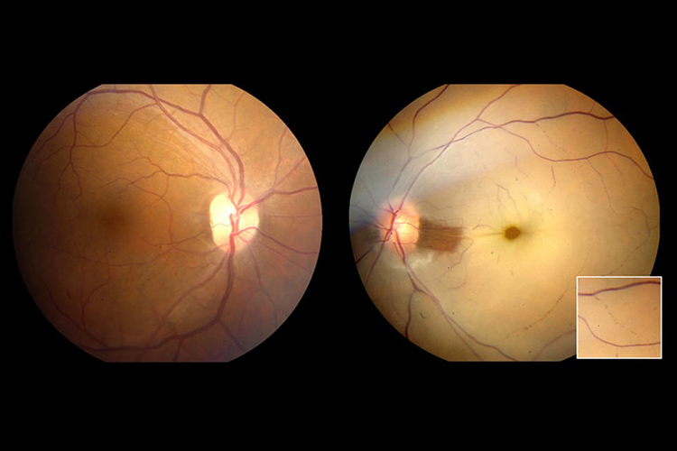 fundus photography of retinas