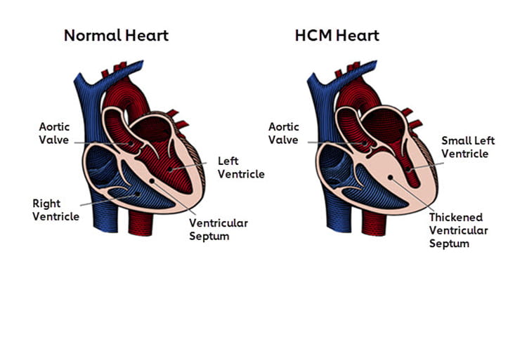 normal heart compared to HCM heart diagram