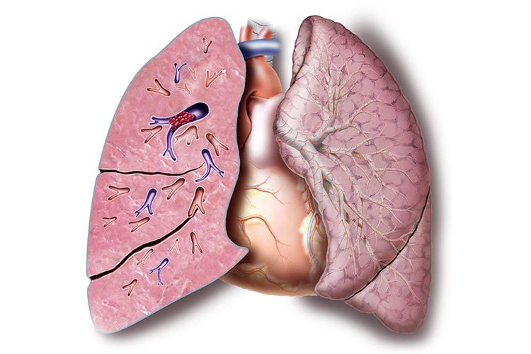 Illustration showing pulmonary embolism