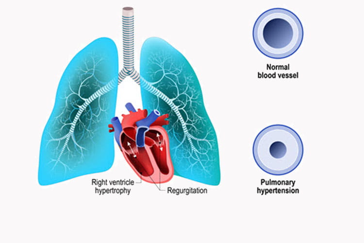 pulmonary hypertension diagram