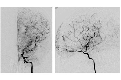 suzuki digital subtraction angiography