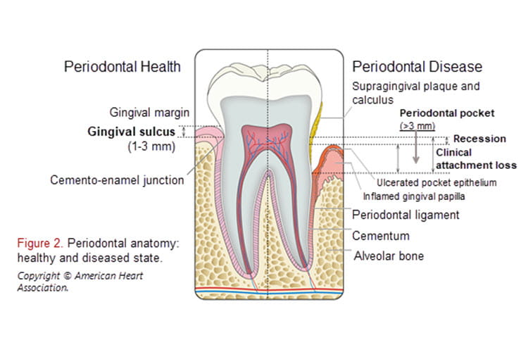 Periodontal Disease & Atherosclerotic Cardiovascular Disease ...