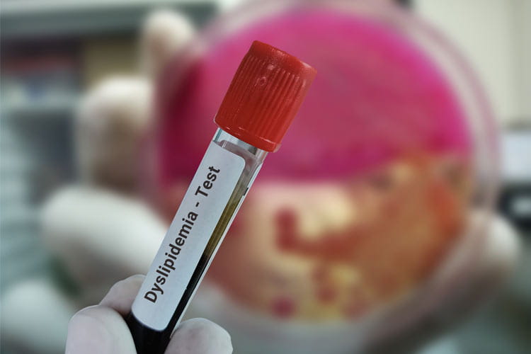 A closeup of a test tube with blood, labeled Dyslipidemia Test.