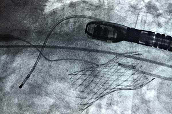 Photo of TAVR Xray mid-surgery