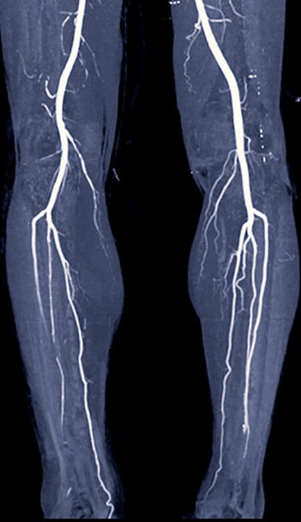 A computed tomography angiography image of a person's peripheral arteries in their legs.