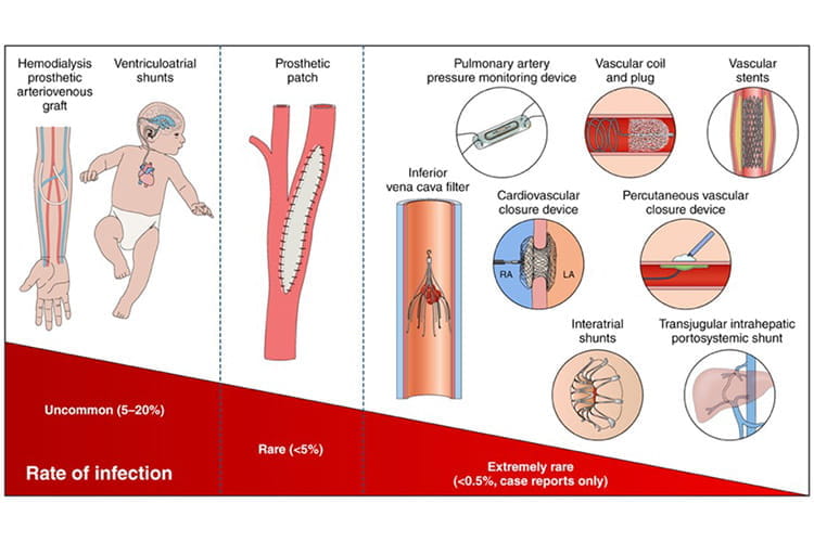 Figure 1 Infections of Selected Nonvalvular Cardiovascular Devices