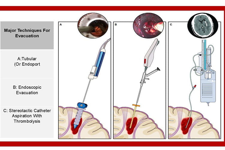 Figure 1: Minimally invasive surgery techniques include (A) tubular retractor with mechanical aspiration, (B) endoscopic evacuation, and (C) stereotactic aspiration, typically combined with adjunctive instillation of thrombolytics, followed by closed-system drainage to gravity over several days. All techniques rely on navigational guidance to preserve brain and white matter tracts. Tubular retractor and endoscopic techniques require a slightly larger device diameter than stereotactic aspiration, but result in immediate evacuation of the hematoma with more rapid reduction of mass effect.