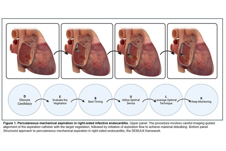Figure 1. Percutaneous mechanical aspiration in right-sided infective endocarditis. Upper panel: The procedure involves carful imaging-guided alignment of the aspiration catheter with the target vegetation, followed by initiation of aspiration flow to achieve maximal debulking. Bottom panel: Structured approach to percutaneous mechanical aspiration in right-sided endocarditis; the DEBULK framework
