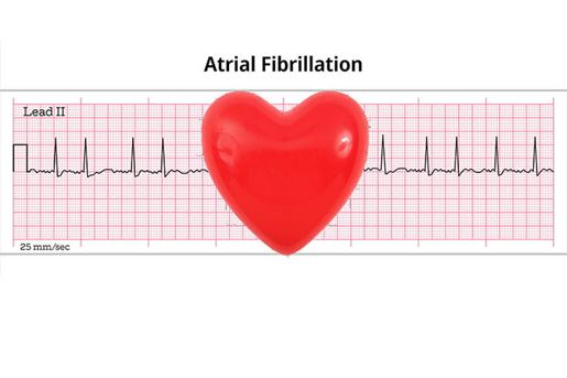 afib illustration