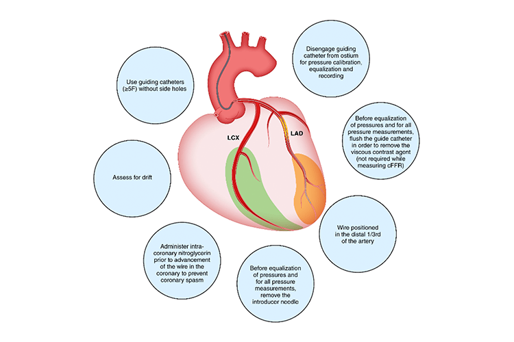 Illustration demonstrating the physiologic assessment of intermediate coronary lesions