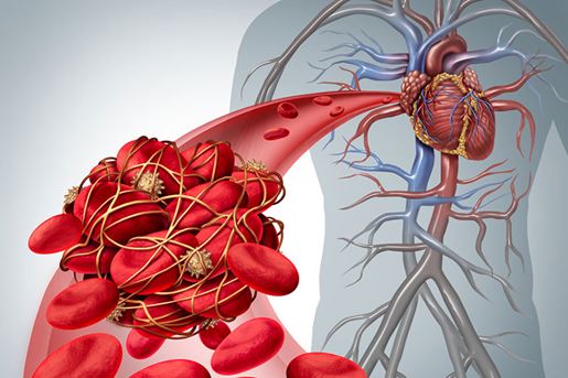 Blood clot illustration