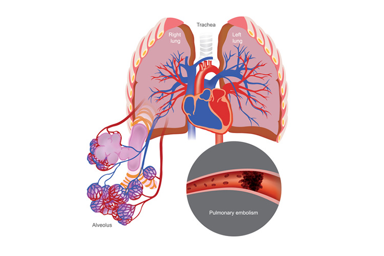 Condition of high blood pressure in the arteries that go from your heart to your lungs