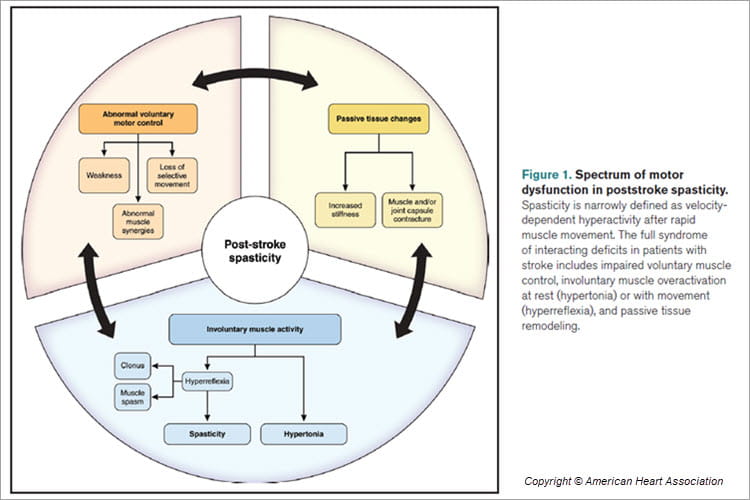 Figure showing spectrum of motor dysfunction in poststroke spasticity