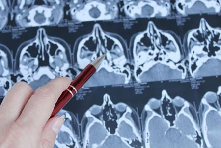 hand pointing a pen at close-up of brain scans