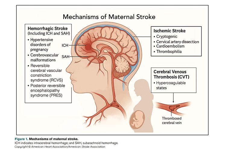 Mechanisms of Maternal Stroke illustration