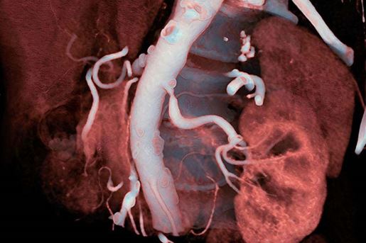 Stenosis of the renal artery