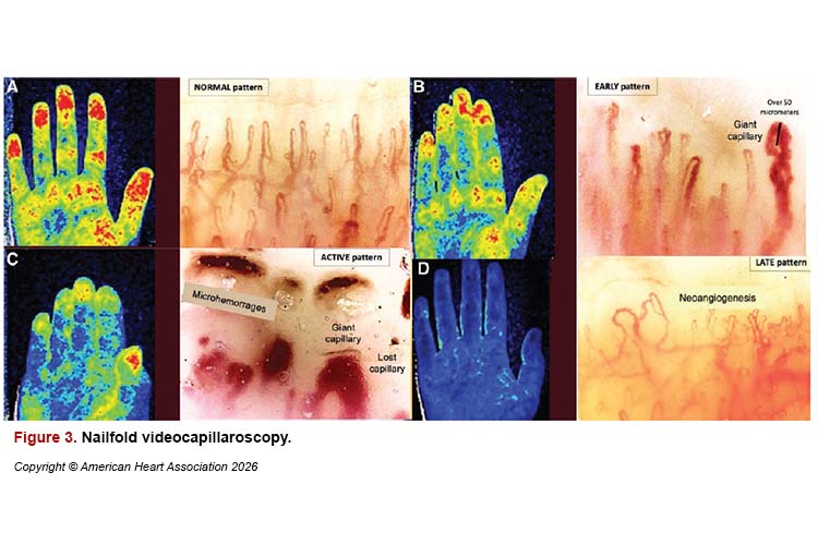 Comparison of nailfold videocapillaroscopy in patients with systemic sclerosis