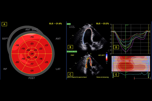 Example of a longitudinal strain assessment output in a patient with normal physiology